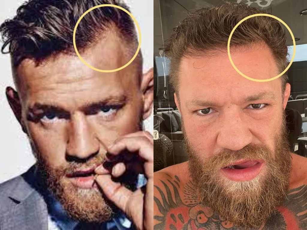 Conor McGregor Hair Loss: Fans Ask - Is He Balding? (Pictures)